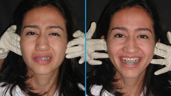 Tratamiento ATM y Funcionales